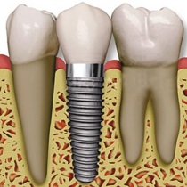 dental implant