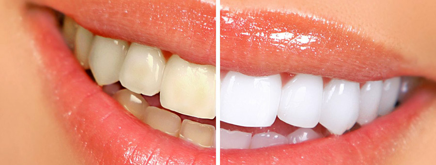 teeth-whitening